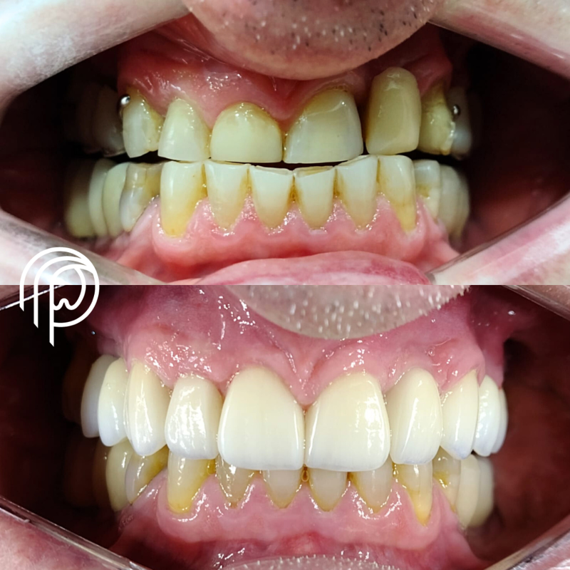 Implantes dentários