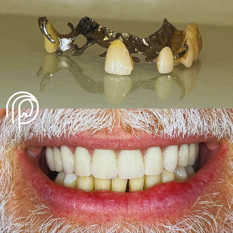 Harmonização do sorriso